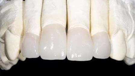 Dental Laboratory Phoenix AZ Ceramic