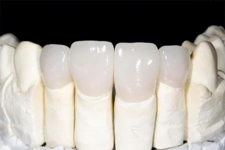 Dental Laboratory Phoenix AZ Ceramic