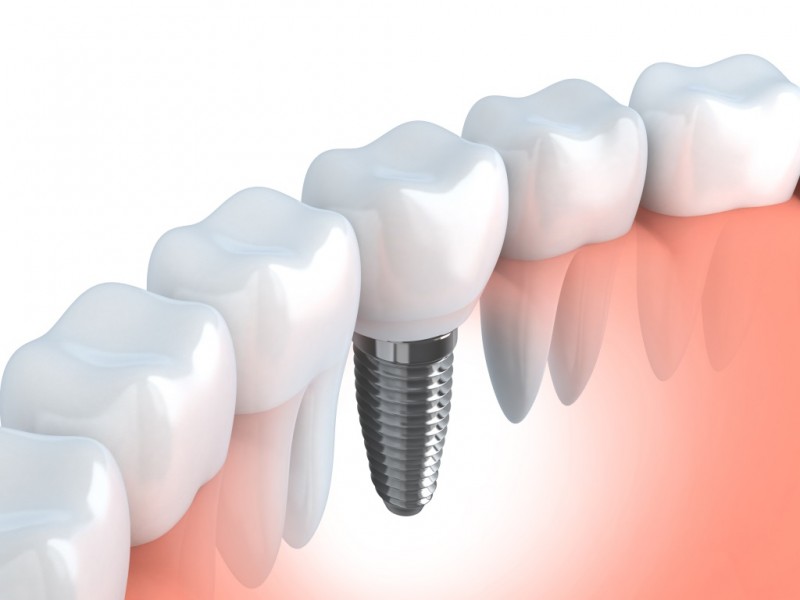 phoenix dental lab implant