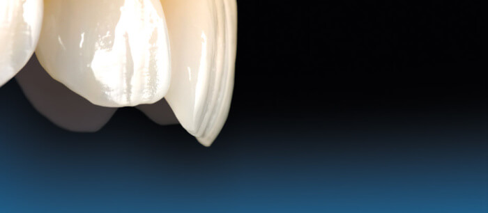 Phoenix Dental Lab ivoclar vivadent ips empress visual