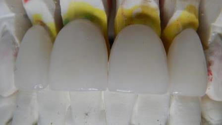 Phoenix Dental Lab Crowns on mold